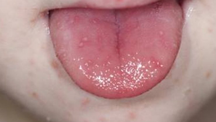 Sıcaklığın artmasıyla birlikte bu hastalıkta da artış yaşanıyor