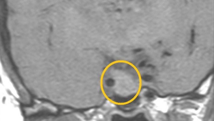 Hipofiz tümörü olan kadın başarılı bir ameliyatla tedavi edildi