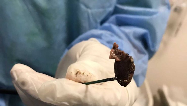 Öksürük şikayetiyle gitti, akciğerinden çekirdek çıktı