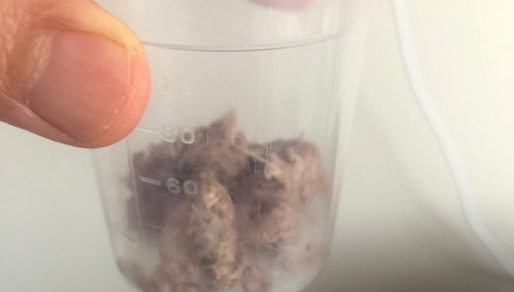 Yemek borusundan 6 santimlik et parçası çıktı