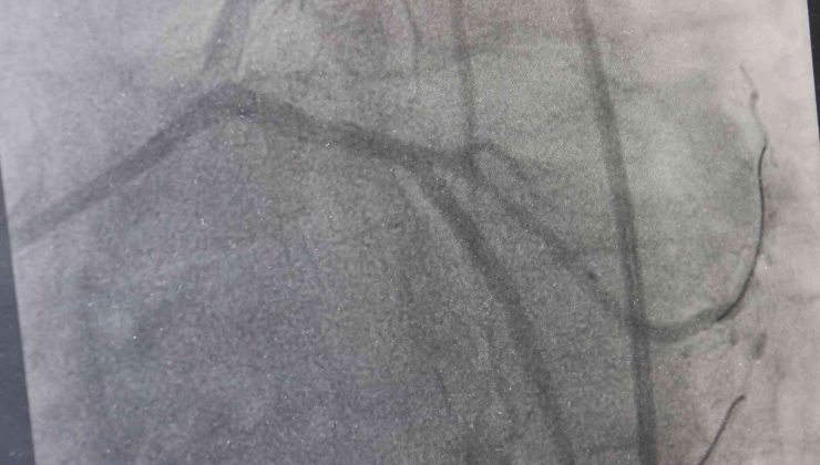 Dünyada yılda 500 bin insanın ölümü trans yağlardan